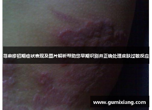 荨麻疹初期症状表现及图片解析帮助您早期识别并正确处理皮肤过敏反应